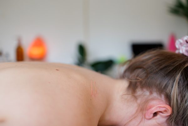 Female lying on front with acupuncture needles in shoulder