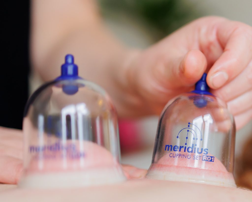 therapist applying cupping therapy cups