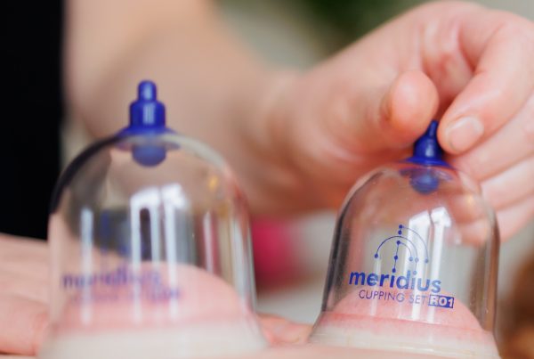 therapist applying cupping therapy cups