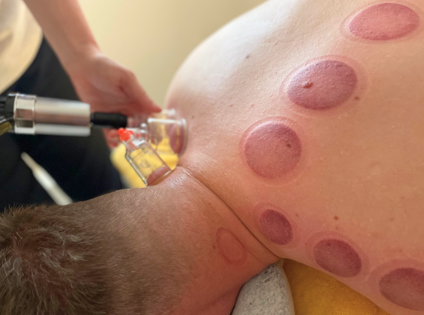 man with marks from cupping therapy while therapist is applying more cups